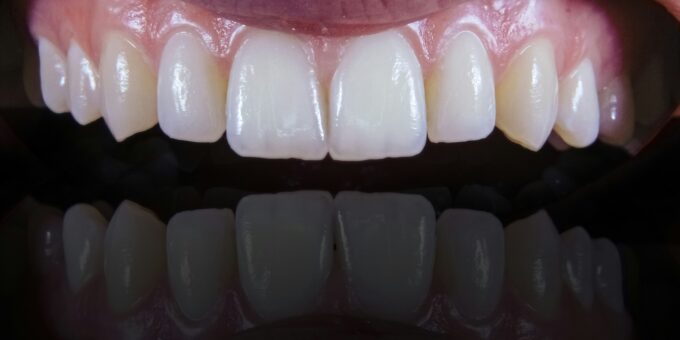 Can Oral Bacteria Make Heart Disease Worse?